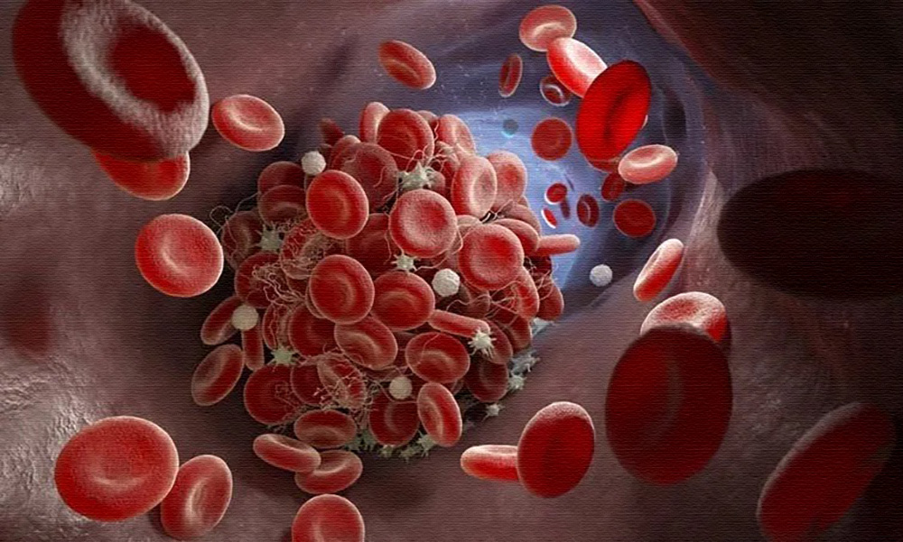 COVID-19 – Mystery Clots In Vaccinated Deceased People